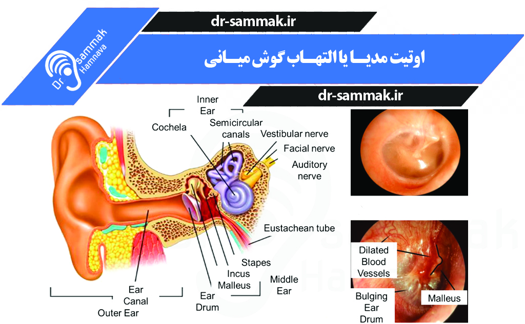 اوتیت مدیا یا التهاب گوش میانی